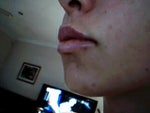 next day after treatment